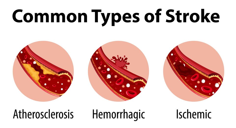 Types of stroke