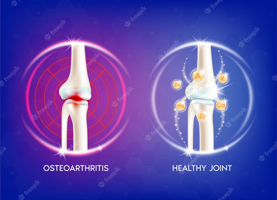 osteoarthritis-vs-healthy-joint