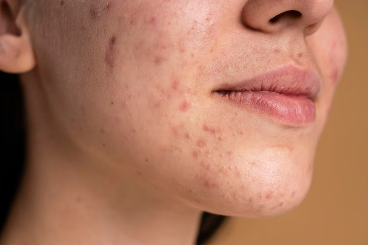 acne in face of a women