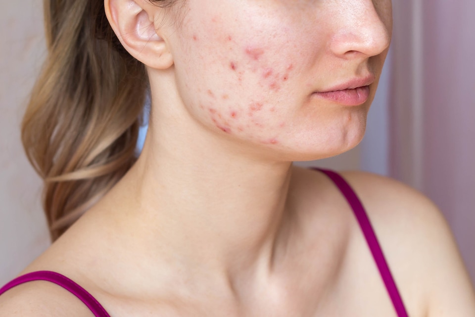 acne-skin-disorder