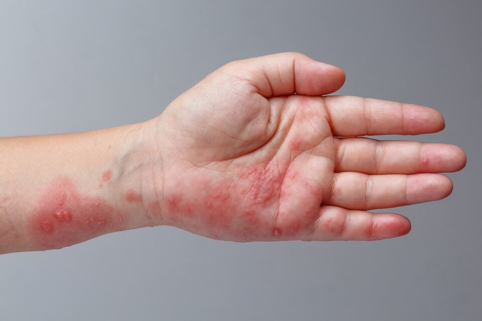 eczema skin disorder.