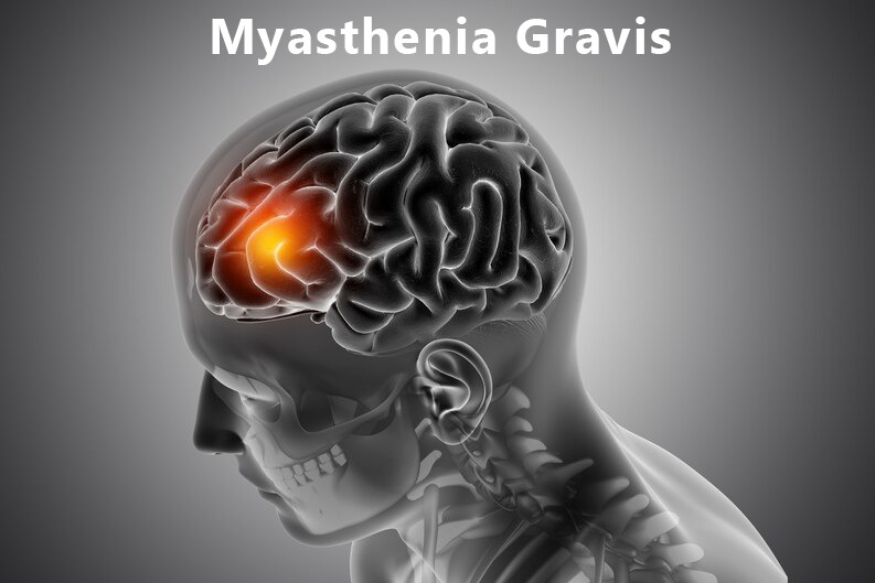 Ayurvedic Treatment for Myasthenia Gravis: Holistic Healing for Muscle Weakness