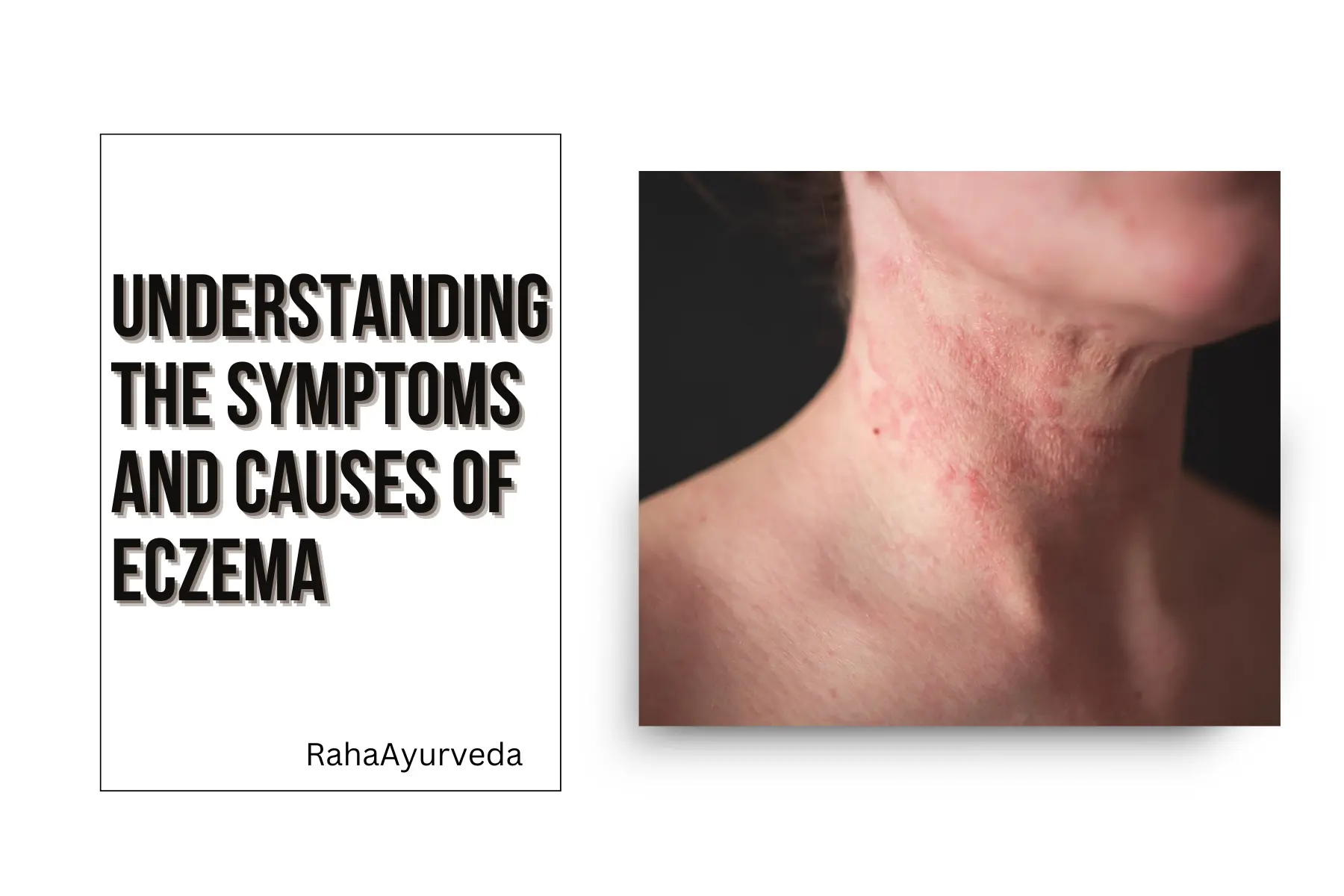 Understanding the Symptoms and Causes of Eczema